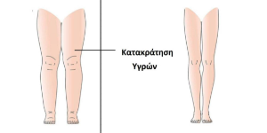 ΚΑΤΑΚΡΑΤΗΣΗ ΥΓΡΩΝ